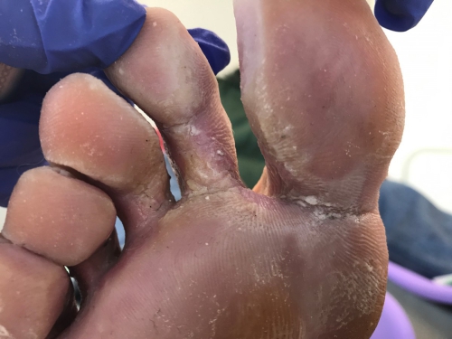 Tinea Pedis